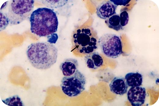 A 47-year-old woman had easy bruising, menorrhagia and anemia with an unremarkable family history. Her physical examination showed a few petechiae on the legs. The white blood count was 1.4 × 109/L, hemoglobin 88 g/L, and platelets were 15 × 109/L. Peripheral blood smear had macrocytosis and hypersegmentation. Initial bone marrow was hypercellular, dyspoietic, with marked erythroid hyperplasia, slight immaturity of the granulocytic series, but with less than 5% blasts, decreased megakaryocytes, an absence of ringed sideroblasts and normal chromosomes. Laboratory tests showed no evidence of nutritional disorders, immune diseases or paroxysmal nocturnal hemoglobinuria. / Myelodysplasia (multilineage dysplasia) was diagnosed and treatment was started with danazol and prednisone. Over the subsequent year, the pancytopenia fully resolved, but temporarily. Six months later, she relapsed with marked pancytopenia. A repeat marrow had prominent dyserythropoiesis with striking erythroid karyorrhexis and abundant nuclear budding (as shown). Blasts were still less than 5%. Six months after, she developed leukemic transformation. / Erythroid karyorrhexis can be seen in several disorders, including congenital dyspoiesis, marked megaloblastic anemia of B12 or folate deficiency, chemical toxicity, severe hemolytic anemia, diGuglielmo's syndrome, and paroxysmal nocturnal hemoglobinuria. Karyorrhexis is also a frequent abnormality in myelodysplasia, but the degree of karyorrhexis that was observed in this patient was unusual.