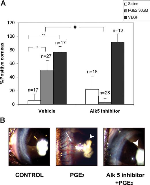 Figure 7. The Alk5 kinase inhibitor SB431542 impairs PGE2-induced mouse corneal angiogenesis. In vivo angiogenesis assays were performed by implanting a pellet containing saline, PGE2 (30 μM), or VEGF (125 ng) together with vehicle or 10 μM SB431542 into a previously created corneal pocket. The angiogenic response was assessed after 6 to 8 days. (A) The chart shows the mean percentage plus or minus SD of positive corneas per condition from 3 independent experiments. n indicates the total number of eyes per condition. *P < .01 vs saline; **P < .001 vs saline; #P < .01 vs PGE2 alone. (B) Representative photographs of corneas from the experiments summarized in panel A; arrowheads, pellets containing PGE2; arrow, positive angiogenic response (note the vessels emerging from the sclerocorneal limbus and reaching the pellet).