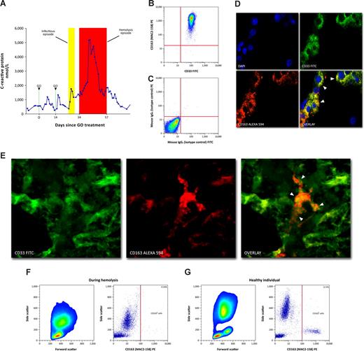 Figure 1. CD163/CD33 coexpression and decreased CD163 expression after treatment with gemtuzumab ozogamicin during intravascular hemolysis (patient 1). (A) Time-course of C-reactive protein (CRP) concentrations after GO-treatment in relation to episodes of infection (yellow area) and hemolysis (red area). (B) Coexpression of CD33 and CD163 on CD14 positive monocytes in healthy: Flow cytometric analysis of CD33 and CD163 expression on CD14 positive monocytes in freshly drawn EDTA-stabilized peripheral whole blood from a healthy individual (results are representative of 5 independent experiments). After gating of mononuclear cells (forward- vs side-scatter) and monocytes (CD14+), cells were replotted with CD33 FITC (FL1) versus CD163 (MAC2-158) PE (FL2). (C) Nonspecific FITC- and PE-conjugated IgG isotype-matched controls served as negative controls. (D) Double immunofluorescence microscopy revealed the simultaneous presence of CD33 and CD163 on Kupffer cells (top left panel: DAPI, blue immunofluorscence; top right panel: CD33, green immunofluorscence; bottom left panel: CD163, red immunofluorescence; bottom right panel: overlay, orange/yellow, marked with white arrowheads; original magnification ×100). (E) Immunofluorescence confocal laser scanning microscopy revealed a colocalization of CD33 and CD163 in bone marrow sections from patient 1 (relapse of acute myeloid leukemia before GO-treatment; left panel: FITC-conjugated anti-CD33, green immunofluorscence; middle panel: biotin-conjugated anti-CD163/streptavidin-conjugated Alexa-Fluor 594, red immunofluorescence; right panel: overlay, yellow, marked with white arrowheads; original magnification ×63). (F,G) Flow cytometric analysis of CD163 expression on peripheral blood cells during the hemolysis episode in patient 1 (F), compared with a healthy individual (G). CD163 positive cells were stained with PE (FL2), showing an almost complete depletion of CD163 positive cells (F; right panel). The results shown here from patient 1 are completely consistent with the data for patient 2, which are shown in Figure S1.