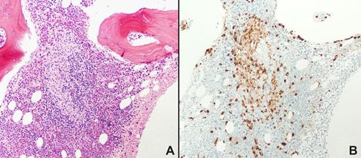Figure 3. Bone marrow biopsy from a patient with systemic mastocytosis. Hematoxylin and eosin staining is shown in panel A, tryptase staining in panel B. Magnification ×100. Note the focal collections of mast cells, major criteria for the diagnosis of systemic mastocytosis. Courtesy of Irina Maric (NIH/Clinical Center, Department of Laboratory Medicine). Images were obtained via digital microscopy using an Olympus BH-2 microscope (Olympus, Melville, NY) equipped with a DPlan 10×/0.65 NA objective. Images were captured using an Olympus DP12 digital camera system and recorded on a 3.3V SmartMedia SSFDC card. Imaging software was Adobe Photoshop version 6.0 (Adobe Systems, San Jose, CA).
