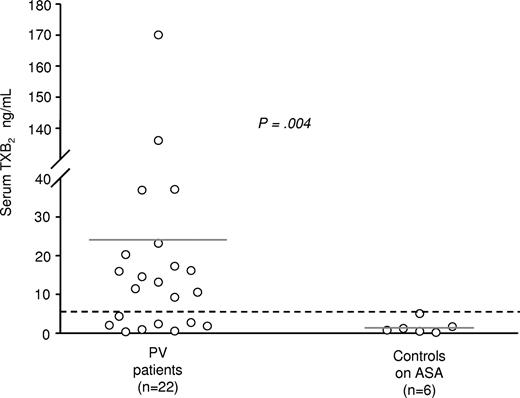 Figure 4. Serum TXB2 levels in polycythemia vera patients. Serum TXB2 levels were measured in polycythemia vera patients (n = 22) as well as in healthy controls (n = 6) after an 8-week treatment with low-dose aspirin (100 mg/od). represents the upper limit of values in healthy volunteers (4.9 ng/mL, mean + 2SD).