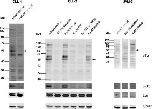 Figure 1. Effect of different kinase inhibitors on global tyrosine phosphorylation and the phosphorylation status of the positively regulating tyrosine residue in SFKs in CLL cells. Fresh PBMCs from 2 CLL patients or the cell line JVM-3 were cultivated for 2 hours and treated with either solvent control or the indicated concentrations of kinase inhibitors. Western blots were developed with primary antibodies directed against phosphotyrosine, pTyr416 of Src, Lyn, or tubulin. The inhibitor effects on patient cells are representative for 3 patient samples. indicate the position of SFK bands.