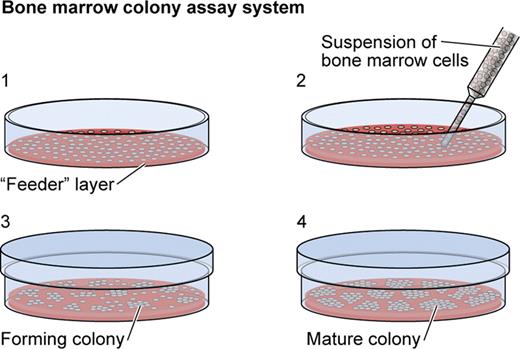 Figure 2. Colony assay led to the identification of the colony-stimulating factors beginning in the late 1960s. “Feeder” layers, containing various types of white blood cells in a semisolid medium, were placed in a small laboratory dish (1). Bone marrow cells (including stem cells) were added to form a second layer (2). When the dish was incubated, colonies of white blood cells formed in the second layer (3). The colonies were counted and the cells identified (4). When the contents of the first layer were varied, different types of colonies formed, implying the existence of a range of colony-stimulating factors. Illustration by Kenneth Probst. Adapted with permission from original artist Patricia J. Wynne. Golde DW, Gasson JC. Hormones that stimulate the growth of blood cells. Sci Am. 1998;259:67.25