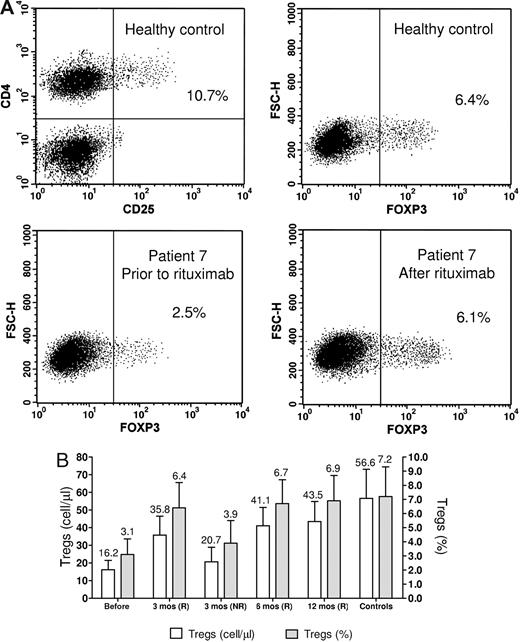 Figure 1. Treg analyses. (A) Flow cytometric analysis of Tregs. The representative upper dot-plots are of a healthy control. The suppressive capacity of Tregs in humans seems to be confined to CD4+CD25+ cells with the highest expression of CD25 (CD4+CD25high) whereas CD4+T cell with intermediate expression of CD25 might also contain recently activated T cells without Treg function. However, because of the lack of a defined cut-off for CD25high expression, the use of this technique does not always offer the reproducible results obtained with the determination of FOXP3-positive cells. The lower plots show the increase of the Treg number following rituximab treatment. Dot plots for CD4+Foxp3+ Treg cells were gated on CD4+CD3+ cells. Numbers on plots are percentages of total cells gated within the respective rectangles. (B) Bar histogram showing Treg counts at the various study points. The counts are shown both as absolute concentrations and as percentage of CD4+ cells. The numbers above the bars are the mean values. Error bars represent SD. Pre indicates pretreatment; R, responders; and NR, non responders.