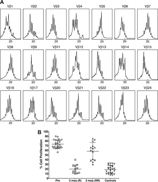 Figure 2. Treg clonality and function. (A) Spectratype analysis of a representative ITP patient prior to ritucximab therapy. The normal TCR VB spectratype pattern consists of 5 to 8 bands and shows a Gaussian distribution in which the density of bands is generally higher in the middle part of the spectratype. Contracted spectratypes consisting of 1 to 4 peaks suggest the presence of a monoclonal (1 dominant peak) or oligoclonal (2-4 peaks) T-cell population. In this case almost all patterns appear polyclonal. (B) Suppressive function of Tregs in ITP. The suppressive function of CD4+CD25+ T cells isolated from the peripheral blood of patients with idiopathic thrombocytopenic purpura in active phase was decreased compared with normal controls, but was restored to normal values in those responding to rituximab. The results are expressed as the percentage of cell proliferation, according to the following formula: percent cell proliferation = (counts per minute of CD4+CD25− plus CD4+CD25+ cells/cpm of CD4+CD25− cells alone) × 100. Pre indicates pretreatment; R, responders; and NR, non responders. The central horizontal bar is the median and the top and bottom bars indicate the SD.
