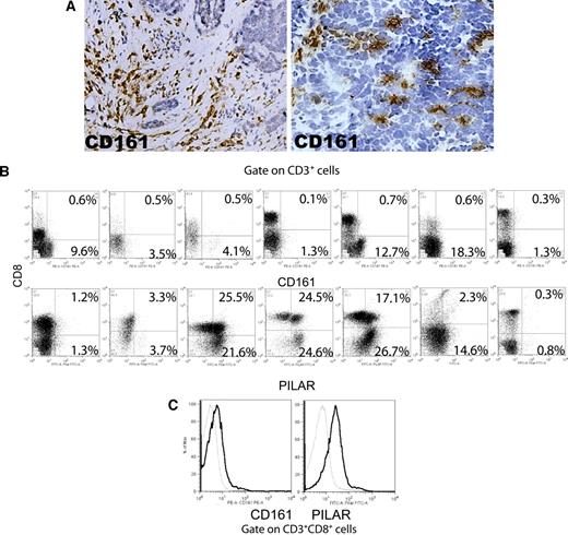 Figure 7. PILAR, but not CD161, is expressed by a proportion of both CD4+ and CD8+ tumor-infiltrating T cells. (A) CD161 is expressed by individual cells in the ovarian carcinoma microenvironment. Data are representative of 20 immunostained specimens. Original magnification, ×100 (left); ×200 (right). Photomicrographs were taken with a Nikon Eclipse 801 (Nikon, Melville, NY) at 10× (left) or 20× (right) 0.30 plan Fluor objective. Images were acquired using Micropublisher v. 5.0 (QImaging, Surrey, BC) and processed using Image ProPlus v. 5.1.1 (Media Cybernetics, Bethesda, MD). (B) PILAR (polyclonal Ab) is expressed by tumor-associated CD4 and CD8 T cells, whereas CD161 is only found on CD4 T lymphocytes. Gated on viable cells. Numbers in quadrants indicate percentage of CD3+ T cells in that quadrant. (C) Expression of both PILAR and CD161 can be recovered on tumor-associated cytotoxic T cells ex vivo by CD3/CD28 (100 ng/mL each) stimulation. Dotted, tumor-derived unstimulated CD8+ T cells; thick, the same cells after stimulation with CD3/CD28 for 5 days. Gated on viable cells.