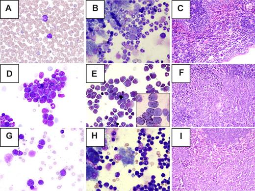 Figure 2. Morphology of tumors detected in ENU-treated PR+ F2 mice. (A-C) Myeloproliferative disease, (D-F) myeloid leukemia, (G-I) lymphoma, (A,D,G) peripheral blood, (B,E,H) bone marrow, and (C,F,I) spleen. (A) Normal lymphocyte and neutrophil. (B) Mild myeloid hyperplasia (secondary to the PR transgene) and normal maturation of all lineages. (C) Normal splenic architecture. (D) Clusters of immature myeloid cells in the peripheral blood. (E) Left shift and expansion of the myeloid lineage in the bone marrow. (Inset) Myeloperoxidase positive blasts. (F) Effacement of splenic architecture by leukemic blasts. (G) Immature lymphoid cells in peripheral blood. (H) Infiltration of bone marrow by malignant lymphocytes. (I) Effacement of splenic architecture by lymphoma cells. Original magnification: ×50 (A), ×40 (C,F,I); ×100 (all others). Images were obtained using a BX40 microscope (Olympus, Center Valley, PA) with UPlanFl 40×/0.75, Plan 50×/0.90 oil iris, and UplsnFl 100×/1.30 oil ∞/0.17 objective lenses. DP70 camera and DP controller software version 2.2.1.227 (Olympus) were used for image acquisition. Photoshop 7.0 (Adobe Systems, San Jose, CA) was used for image preparation.