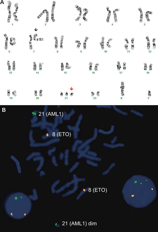 Figure 1. Karyotype and FISH analysis in patient 1. (A). Cytogenetic analysis of peripheral blood abnormal cell showing duplication of 7p14-p15 (black arrow) and 3 copies of chromosome 21 (red arrow). (B). FISH on peripheral blood using probes specific for ETO (orange) and RUNX1 (green) genes. Note the presence of one strong and one dim green signal in the metaphase and lower left interphase nucleus confirming the constitutional RUNX1 deletion. In the lower right interphase nucleus there are 1 strong and 2 “dim” RUNX1 signals, representing a trisomy 21 cell line with duplication of the deleted chromosome 21.