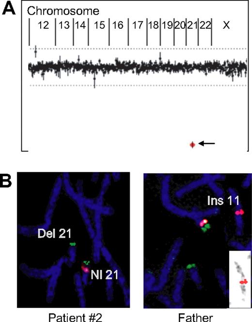 Figure 2. Array-CGH and FISH analyses of patient 2. (A). An output of the clinical array-CGH (CMA V6.3) of patient 2. This profile represents the averaged combined data of hybridizations performed using reference DNA. Oligonucleotides emulating the clone RP11-17O20 (arrow) shows down displacement, indicating a loss of chromosome 21 material in the patient versus the reference DNA. (B). Representative data from metaphase FISH analysis in patient 2 and her father. The RP11-17O20 clone was used as probe (red). The green signal is a subtelomeric probe used as a control. The patient has a single red signal consistent with a deletion on 1 of the 2 copies of chromosome 21. The FISH analysis in the father shows one red signal on chromosome 21 and the second signal inserted in the long arm of chromosome 11. Reverse banding (inset) confirmed the insertion to chromosome 11.