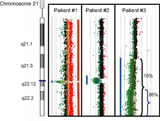 Figure 3. Agilent 244K Human Genome CGH Microarray hybridization profile of chromosome 21 for the 3 patients. The size of the deletions is indicated by the blue bars. The small microdeletion in patient 1 is embedded within a profile that shows copy number gain with all the other oligonucleotides from chromosome 21 (red bar) reflecting the trisomy 21. The profile of patient 3 shows that the deflection of the log2 ratio (the green deflection from 0) is not uniform, indicating the presence of mosaicism in the cell population. On the basis of the FISH data, only 15% of the cells in patient 3 have the large (approximately 19.7 Mb) deletion and are deleted for the RUNX1 gene.