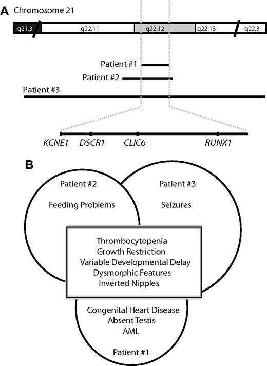 Figure 4. Summary of the genetic and clinical findings in our patients. (A) Schematic representation of the deleted regions on 21q22.12 (not drawn to scale). The deletion map was constructed using the USCS human genome browser (http://genome.ucsc.edu/). The black lines show the extents of the deletions. The shaded area is the overlap between the deletions in the 3 patients. The genes located within this interval are at the bottom of the figure. (B) Diagram of the shared and unique clinical features of the 3 patients described in this report.