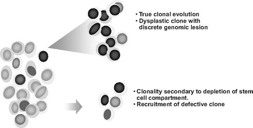 Figure 1. Clonality in hematopoietic diseases. Chromosomal abnormalities or somatic mutations can be used as markers of clonality. Clonal defects (a pathogenic lesion or a marker indicative only of clonality) can be detected by, for example, SNP-A–based karyotyping (sensitivity problem) only if present in a significant proportion of cells. True malignant expansion of the dominant clone has to be contrasted with the clonality due to contraction of the cell compartment resulting in a recruitment of only one or a few stem cells at any given time.