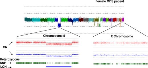 Figure 4. Principle of bioinformatic analysis of array output. Analysis of hybridization signal intensity for each SNP probe allows for construction of karyograms. In this example, CNAG v.2 software (www.genome.umin.jp/CNAGtop2.html) was used for analysis: colors result from merging of individual signals grouped based on the topographic distribution throughout the genome and correspond to each of the autosomes and the X-chromosome. The hybridization signal intensity plot results in trace colors oscillating around the diploid signal intensity value. In the example shown, multiple areas of hypoploid signal intensity can be distinguished corresponding to several genomic losses. Zooming in on 2 exemplary chromosomes (5 and X, below the whole genome view) demonstrates the copy number determination plot (red dots symbolize hybridization signals of single SNP probes; blue line represents average copy number) as well as heterozygosity tracing depicted using individual green ticks (which merge when the density of heterozygosity calls is high). Areas of deletion are recognizable by the decrease in the hybridization signal intensity (below the diploid line) and corresponding decrease in the expected density of heterozygosity calls. Of note is that residual heterozygosity calls (here in an example of del5q31) correspond to signals derived from nonclonal cells contaminating the sample.