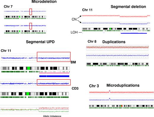 Figure 5. Examples of types of defects detected by SNP-A. Various types of chromosomal lesions detectable by SNP-A are presented, including microdeletions and microgains, large segmental or numeric gains, losses, and segmental acquired UPD. For demonstration purposes, the somatic nature of an exemplary microdeletion detected in bone marrow is demonstrated by comparison with sorted, nonclonal CD3 cells from the same patient. The karyogram of CD3 cells shows 2 normal chromosomes 7. Below, a similar demonstration is provided for an exemplary UPD with a disparity in the density of heterozygosity calls between clonal bone marrow sample and nonclonal sorted CD3 T cells.