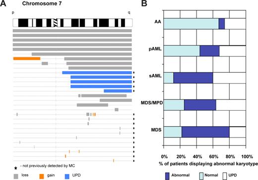Figure 8. SNP-A karyotyping allows both mapping of invariant lesions and improvement of detection rate of cytogenetic abnormalities. (A) Mapping of chromosomal aberrations in myeloid malignancies. Karyograms generated by SNP-A allow for mapping of the location of chromosomal aberrations and delineation of minimal commonly deleted regions (as an example, topography of lesions on chromosome 7 is shown based on the analysis of a cohort of patients with AML and MDS). (B) Summary of the SNP-A karyotyping results. In representative studies of patients, including 78% of MDS, 75% of MPD/MDS, 87% of sAML,32 30% of AA (M. Wlodarski, L. Gondek, C. L. O'Keefe, R. Tiu, A. Haddad, A. Risitano, J.P.M., manuscript submitted May 2008), and 56% of primary AML (R. Tiu, C. L. O'Keefe, M. Sekeres, M. A. McDevitt, J. Karp, J.P.M., manuscript submitted June 2008) patients were analyzed using SNP-A, and the rates of detection of chromosomal abnormalities, including UPD, were calculated.