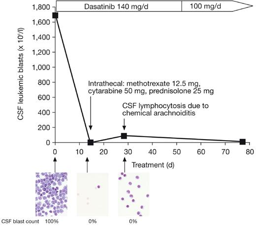 Figure 3. Clinical efficacy of dasatinib monotherapy in the treatment of CNS leukemia in an index patient with relapsed Ph+ ALL. CSF blast count was performed from May-Grünvald-Giemsa–stained cytospin slides by counting 100 to 300 cells. Microscopy slides were viewed with Zeiss Axioskop 40 light microscope (Carl Zeiss Microimaging, Jena, Germany) using Plan-Apochromat 63×/1.4 oil and Plan-Neofluor 100×/1.3 oil objective lenses. Images were acquired using Axiocam HRC digital camera (Carl Zeiss Microimaging) and were processed with Axiovision AC 4.2 software (Carl Zeiss Microimaging).