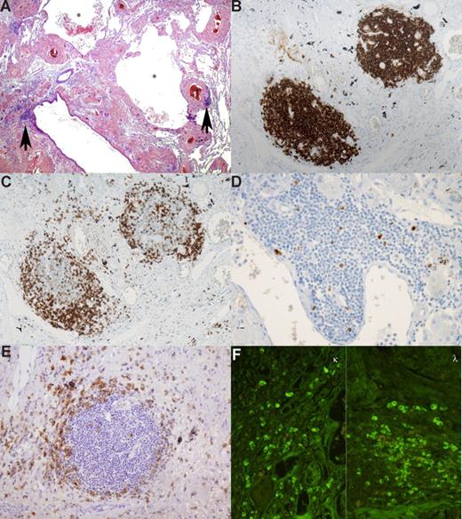 Figure 1. Pulmonary lymphoplasmacytic infiltrate. This low-power view shows abundant eosinophilic amorphous extracellular pulmonary deposits associated with several cysts (*). Three lymphoid nodules are seen, and 2 of them () are located in the vicinity of bronchioles (A). Immunohistochemical study revealed that the nodules are composed mainly of small CD20+ lymphocytes (B). At the periphery, small CD5+ cells were present (C). Less than 5% of lymphocytes were labeled by anti–Ki-67 antibody (D). Anti-CD138 antibody highlights the presence of plasma cells around the nodules (E). IF performed on deparaffined sections demonstrated that plasma cells did not show light chain restriction (F). All slides were examined on a Zeiss Axioplan microscope equipped with an epifluorescent illuminator (Zeiss, Jena, Germany). Original magnification 20×/0.075 objective.