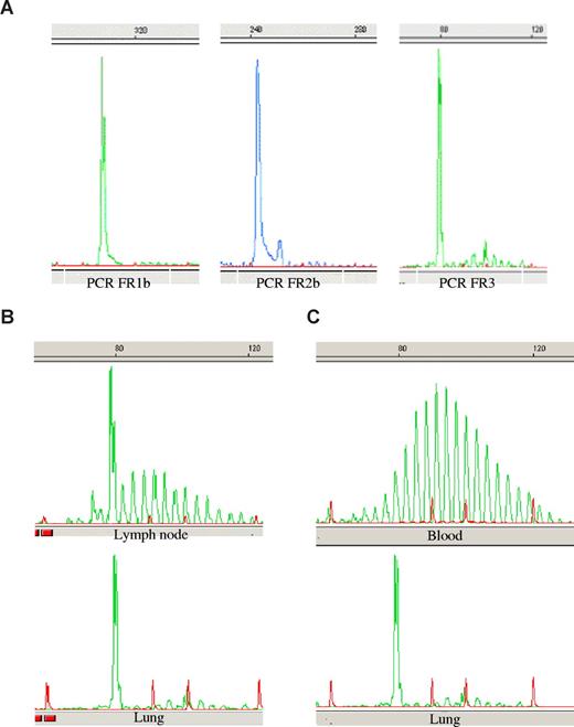 Figure 2. Genscan analysis of PCR products. Amplifications of immunoglobulin heavy chain CDR3 sequences were performed using the 3 FR1, FR2, and FR3 primer sets. PCR products were run on a sequence analyzer and sizes were determined using a size marker (in red) and the Genscan software. The figure shows representative data in patient 1 of (A) the dominant clone detected in the lung, (B) the PCR product alignment of lung and lymph node dominant clone, and (C) the comparison of lung clone and polyclonal blood B-cell repertoire.