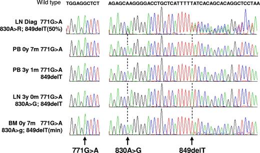Figure 3. Sequencing experiments. Each peak on electropherograms represents one base (green indicates A; red, T; blue, C; and black, G). The wild-type sequence is indicated at the top. All experiments were performed from biologic samples obtained from the same patient (no. 655). For each, the nucleotides around position 771 and the 825 to 869 segment are shown. Each experiment is identified by the nature of the biologic sample (LN indicates lymph node; PB, peripheral blood; and BM, bone marrow) and by the time from diagnosis at which it was obtained (diag). The 771G>A mutation, shared by all samples, shows the clonality of the disease. From the 3 later samples, where different subclones dominate, it can be deduced that the 771G>A mutation was acquired first, followed by the 849del and by the 830A>G. The last example shows that the sensitivity of the technique allows for the detection of minor subclones.