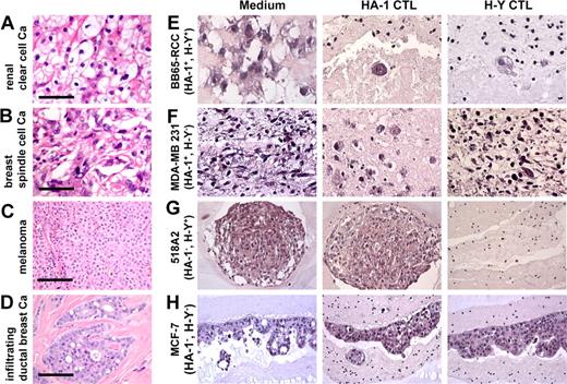 Figure 2. HA-1 CTLs eradicate 3D microtumors mimicking primary tumors. H&E stainings reveal that microtumors (E-H medium controls) closely resemble the histologies of the corresponding primary tumors (A-D). BB65-RCC microtumors (E) show clear cells similar to a primary intermediately differentiated renal cell carcinoma (A). MDA-MB 231 microtumors (F) contain spindle-formed cells without orientation similar to a primary spindle cell carcinoma of the breast (B). 518A2 microtumors (G) show sheets of cells similar to a primary melanoma (C). MCF-7 microtumors (H) show acinus-like structures similar to a primary intraductal carcinoma (D). (E-H) HA-1 and H-Y CTLs destroy microtumors in a strictly mHag-specific manner, resulting in strongly reduced cellularity and cell debris. Bars in top 2 rows represent 100 μm; in bottom 2 rows, 50 μm.