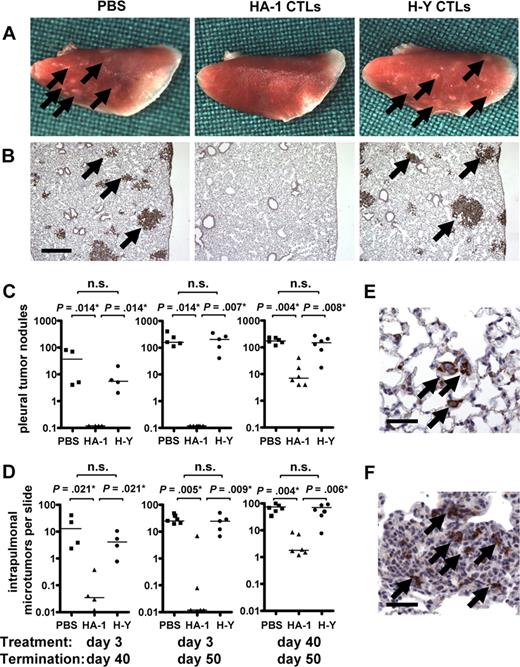 Figure 5. HA-1 CTLs prevent and inhibit the progression of pulmonary metastases. NOD/scid mice received human HA-1+/H-Y− MDA-MB 231 breast cancer cells intravenously on day 0 and were treated with PBS or 30 × 106 HA-1 or H-Y CTLs intravenously. (A,B) Depicted are representative examples of lungs of mice that had been treated with PBS (left), the HA-1 CTL clone 1.7 (middle), and the H-Y CTL clone 21–17 (right) on day 3 and killed on day 50. Larger pleural tumor nodules are macroscopically visible (A). Cytokeratin staining shows microtumors in the pulmonary interstitium of which some were subpleurally localized; bar represents 500 μm (B). Arrows indicate tumors. (C,D) Quantification of pulmonary tumors of mice that had been treated on day 3 and killed on day 40 (left graphs; 4 mice per group, 5 × 105 tumor cells per mouse) or on day 50 (middle graphs, 5-6 mice per group, 7.5 × 105 tumor cells per mouse); quantification of pulmonary tumors of mice that had been treated on day 40 and killed on day 50 (right graphs, 6 mice per group, 7.5 × 105 tumor cells per mouse). X-axis represents treatment with PBS, HA-1, or H-Y CTLs; y-axis, number of pleural tumor nodules visible on the intact lungs (C) or number of intrapulmonal microtumors per parallel section (D). Numbers of lung tumors were pairwise compared in different groups of mice by Mann-Whitney U test. n.s. indicates not significant. (E) Cytokeratin staining of single tumor cells in the lungs of mice 3 days after intravenous administration of MDA-MB 231 tumor cells; bar represents 50 μm. (F) CD8 staining of a pulmonary metastasis of mice that had been treated on day 40 with HA-1 CTLs and killed on day 50. Arrows indicate CD8+ CTLs; bar represents 50 μm.