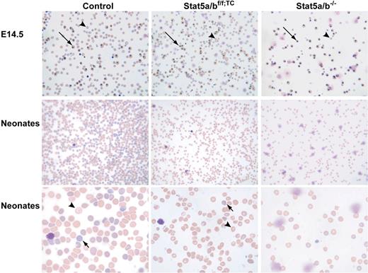 Figure 1. Peripheral blood smears from control, Stat5a/bf/f; TC, and Stat5a/b−/− E14.5 embryos and neonates, subjected to Giemsa staining. Peripheral blood smears revealed microcytosis, anisocytosis, and hypochromia in Stat5a/b mutant mice, suggestive of iron deficiency. An increase in nucleated erythroblasts (long →) and reticulocytes (short →) further indicates stressed erythropoiesis in mutant mice. indicates mature red blood cells. Original magnifications: top and middle panels, ×200; bottom panel, ×600.