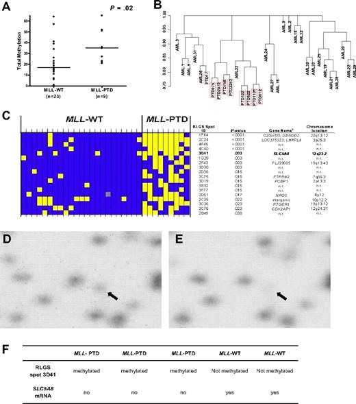 Figure 1. Differential global DNA methylation between CN-AML with and without MLL-PTD. (A) Each RLGS autoradiograph was viewed independently by 3 trained individuals who catalogued each spot loss or gain in comparison to a reference RLGS autoradiograph generated using normal donor BM DNA. RLGS data were compiled for all patients and 321 spots were evaluable across all profiles. Global DNA methylation, that is, the number of methylation events observed, was determined for each patient and a comparison of global DNA methylation between MLL-WT and MLL-PTD AML groups, was made using the Wilcoxon rank sum test. Horizontal bars represent the medians. (B) Unsupervised hierarchical clustering of patients was carried out based on RLGS spots that were methylated in at least one patient (265 spots). Jaccard binary similarity metric was used. (C) The 18 RLGS spots with the strongest association, measured by Fisher exact test, between methylation and MLL AML groups are shown. Yellow squares represent a methylated locus; blue squares represent an unmethylated locus; gray squares indicate spot was not evaluable. Columns represent individual patients and rows represent RLGS spots. RLGS spot names are shown on right. Row 5 depicts results for RLGS spot 3D41, that is, a DNA fragment corresponding to a region of the SLC5A8 promoter and exon 1. The corresponding gene names and chromosomal locations, if known and as reported in Supplemental Table 5 from Smiraglia et al27 are also shown. (D) RLGS was carried out as described in “Methods.” The area of the autoradiographs containing spot 3D41 (arrow) were scanned using a Storm 860 phosphorimager (Molecular Dynamics, Amersham Biosciences, Piscataway, NJ) and area with 3D41 enlarged (Photoshop v.8.0, Adobe Systems, San Jose, CA). Representative results are shown for the presence of 3D41 in a primary MLL-WT AML patient sample. (E) Representative RLGS results showing nearly complete loss of 3D41 in a primary MLL-PTD AML patient sample. (F) SLC5A8 mRNA detection in primary AML patient samples that exhibited loss or presence of RLGS spot 3D41.