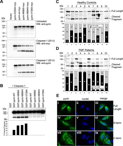 Figure 2. Cleavage of FMF-associated mutant pyrins by caspase-1 and cellular localization of cleaved fragments. (A) Myc-tagged D330A, WT, or FMF-associated mutant pyrin was transfected into PT67 cells. After 24 hours, cell lysates (10 μg total protein) underwent Western blotting with antipyrin Ab (top). The same amounts of lysates were incubated with 20 units of recombinant caspase-1 for 10 minutes at room temperature. The incubated cell lysates were subjected to Western blotting with antimyc, detecting the C-terminal cleavage fragment (middle), and antipyrin Abs, detecting the smaller N-terminal cleavage fragment (bottom). (B) GST-fused WT or mutant pyrin was cotransfected into PT67 cells with (lanes 1-5) or without (lanes 6-9) caspase-1. Cell lysates were analyzed by Western blots using antipyrin Ab (top panel). The cleaved and uncleaved pyrin fragments were quantified by densitometry and represented as percentage of total pyrin (bottom panel). (C,D) Lysates of PBMCs from 10 healthy individuals (C) and 10 FMF patients (D) were subjected to SDS-PAGE, and Western blotting with antipyrin Ab. Exposure times were the same for panels C and D. The full-length and cleaved pyrin were quantified by densitometry and represented as percentage of total pyrin. (E) HeLa cells were transfected with myc-tagged full-length pyrin (i-iii), N-terminal cleaved pyrin (iv-vi), or C-terminal cleaved pyrin (vii-ix). After 24 hours, cells were fixed with 4% paraformaldehyde in PBS, and stained with AlexaFluor 488–conjugated antimyc Ab (green), counterstained with DAPI (blue), and visualized on a Leica DMR microscope. Pyrin variants are shown in the first column (i, iv, and vii); nuclei are in the second column (ii, v, and viii); merged images are in the third column (iii, vi, and ix).