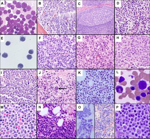 Figure 4. A histopathological montage of normal and malignant human B-lineage cells. (A) Bone marrow aspirate of ALL cells exhibiting a high nuclear to cytoplasmic ratio, finely dispersed chromatin, indistinct nucleoli, and blue-gray cytoplasm. (B) Bone marrow biopsy showing effacement of the marrow architecture by a monotonous population of ALL lymphoblasts. (C) Representative normal lymph node follicle showing a reactive GC surrounded by mantle zone. (D) MCL cells display a heterogeneous morphology ranging from small round (true mantle zone/CLL-like) cells to those showing irregular cleaved nuclei (FL-like). (E) A peripheral blood sample of CLL cells exhibiting closely condensed chromatin, indistinct nucleoli, and scant basophilic cytoplasm with a regular outline. (F) Normal GC centrocytes with vesicular chromatin and irregular nuclear outlines, along with larger round centroblasts showing a similar open chromatin. (G) FL with a predominance of small cleaved centrocyte-like cells demonstrating significant nuclear irregularity. (H) DLBCL with classic post-GC immunoblastic morphology exhibiting a large nucleus, eosinophilic nucleoli, vesicular chromatin, and relatively abundant cytoplasm. (I) Biopsy from an abdominal mass showing BL cells with a monomorphic infiltrate of small to intermediate-sized cells with round nuclei, indistinct nucleoli, clumped chromatin, a basophilic cytoplasm, and a high apoptotic cell index. (J) A characteristic Reed-Sternberg cell (arrow) in HL. The cells are large and binucleated, with mirror image nuclei, demonstrating prominent eosinophilic nucleoli. Many of the other cells in the background are reactive lymphocytes. (K) Bone marrow biopsy showing hairy cell leukemia. The cells are evenly spaced from each other with round nuclei and clear abundant cytoplasm, imparting a “fried egg” appearance to the cells. (L) Peripheral blood smear of hairy cell leukemia (HCL) demonstrating classic concentric hairlike cytoplasmic projections. (M) MZL cells with a heterogeneous appearance ranging from small round cells to those manifesting a cleaved morphology. (N) WM/lymphoplasmacytic lymphoma showing considerable morphologic overlap with MZL. The cells demonstrate significant plasmacytoid features with pseudointranuclear inclusions (ie, Dutcher bodies). Many of the plasmacytoid cells contain globular collections of paraprotein in the cytoplasm, imparting a mulberry-like appearance to the cell. (O) Two cases of MM within the marrow. The cells show typical plasma cell features including the eccentrically disposed nucleus and abundant Ig-containing cytoplasm. (P) PL comprising enlarged plasmacytoid cells with enhanced atypia; mitoses are easily identifiable. All photographs were taken with an Olympus BX41 microscope and DP71 camera (Olympus America, Center Valley, PA). The images were acquired using the following UPlanFL N objective lenses: panels A,E,J,L,M,O, P: 100×/1.30, oil immersion; panels B,F,G,H,I,K,N: 40×/0.75; panels C,D: 20×/0.50. Panels A, L, and O are Giemsa stains; all others are H and E stains. Images were assembled using Adobe Photoshop version 9.0.2 (Adobe Systems, San Jose, CA). Panels A and E were provided by Dr Amy Chadburn, and all other images were provided by Dr Cynthia Magro, both from the Weill Medical College of Cornell University, New York, NY.