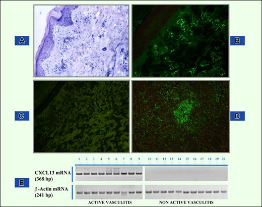 Figure 1. Demonstration of CXCL13 protein and CXCL13 mRNA in skin biopsy samples. (A) Hematoxylin and eosin staining of skin sample from a patient with cryoglobulinemic active vasculitis. Magnification, 10×/0.25. (B) CXCL13 protein immunofluorescence staining in skin biopsy showing feature of active vasculitis. CXCL13- specific signal appears as linear green deposits along collagen bundles. Magnification, 10×/0.25. (C) Complete absence of CXCL13 immunoreactant in skin tissue of an MC patient without active phase of vasculitis. Magnification, 10×/0.25. (D) Positive control staining in human tonsil. Magnification, 20×/0.40. (E) RT-PCR analysis of CXCL13 mRNA extracted from MC patients with and without active cryoglobulinemic vasculitis.