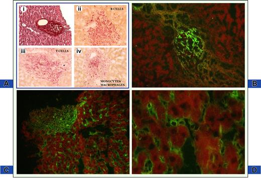 Figure 2. CXCL13 immune deposits in the liver of HCV-infected patients. (A) Hematoxylin and eosin staining of liver biopsy from an MC patient. Note enlarged portal tract containing infiltrating inflammatory cells with follicle-like structure (Ai; magnification, 10×/0.25). Phenotypic characterization of inflammatory cells is depicted in panels Aii to Aiv. Magnification, 20×/0.40. B cells, T cells, and monocytes/macrophages were studied by indirect immunohistochemistry using mouse anti-CD3, anti-CD20, and anti-CD68 antibodies and revealed with antimouse immunoglobulins conjugated with alkaline phosphatase in sections adjacent to panel Ai. All 3 cell populations are abundantly present within inflamed portal tract. (B) Follicle-like appearance of CXCL13 protein restricted to a portal tract structure on a section adjacent to panel A. Magnification, 20×/0.40. (C) CXCL13 deposits are homogeneously distributed in portal tract and in hepatic sinusoids. Magnification, 20×/0.40. (D) Higher magnification (63×/0.75) demonstrates that CXCL13 is present on intrasinusoidal inflammatory cells and along sinusoidal walls.