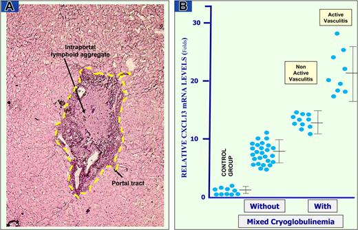 Figure 3. CXCL13 mRNA expression in LCM-based portal tracts. Example of LCM is reported in panel A. An enlarged portal tract with heavy inflammatory infiltrate and lymphoid aggregate with the appearance of lymphoid follicle was dissected by laser beam along the yellow dotted line from cryostat section of liver biopsy. (B) Quantitative real-time RT-PCR performed on nucleic acids extracted from microdissected portal tracts of HCV-infected patients without and with MC and controls. Data are means plus or minus SD for each group.