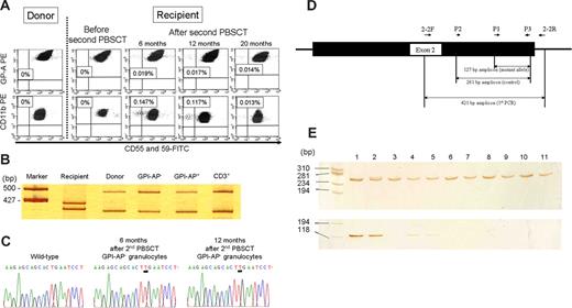 Figure 1. Analysis of PNH-type cells after the second PBSCT. (A) High-sensitivity flow cytometry detected small populations of CD55−CD59−cells in both granulocytes and red blood cells at the development of the second LGF as well as in those obtained 6 and 12 months later, but did not detect PNH-type cells in the donor or in the recipient before the second PBSCT. The numbers denote the proportion of PNH-type cells in CD11b+ granulocytes or glycophorin A+ RBCs. (B) D1S80 allelic patterns of sorted GPI-AP− granulocytes, GPI-AP+ granulocytes, and CD3+ lymphocytes. The polymerase chain reaction (PCR) products were subjected to 8% polyacrylamide gel electrophoresis and visualized by silver staining. (C) Nucleotide sequences of PIGA exon 2 in DNA from PNH-type granulocytes obtained 6 and 12 months after the second PBSCT. (D) A schematic illustration for ARMS-PCR is shown. Primer positions for the first, second are shown by short arrows. A black box and adjacent lines represent exon 2 and introns, respectively. (E) Amplified products of control PCR (the upper gel) and ARMS-PCR (the lower gel) were electrophoresed in 12.5% polyacrylamide gel and visualized by the silver staining. A pMD20-T vector containing the mutated exon 2 fragment was used as a positive control for ARMS-PCR. The template DNA derives from a plasmid containing the mutated exon 2 in lane 1, donor BM in lane 2, donor PB in lane 3, recipient BM in lane 4, recipient PB in lane 5, and BM from healthy individuals in lanes 6 to 11. PCR with a 5′ primer specific to the nucleotide sequence upstream of the mutated sequence amplified a 261 bp fragment from DNA of the donor and all healthy individuals.