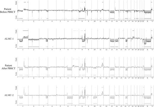 Figure 4. Genome-wide high resolution aCGH. Chromosomal copy number alterations across the pre-PBSCT, ALMC-1, post-PBSCT, and ALMC-2 cells are plotted for each probe evenly aligned along the x-axis in chromosomal order.
