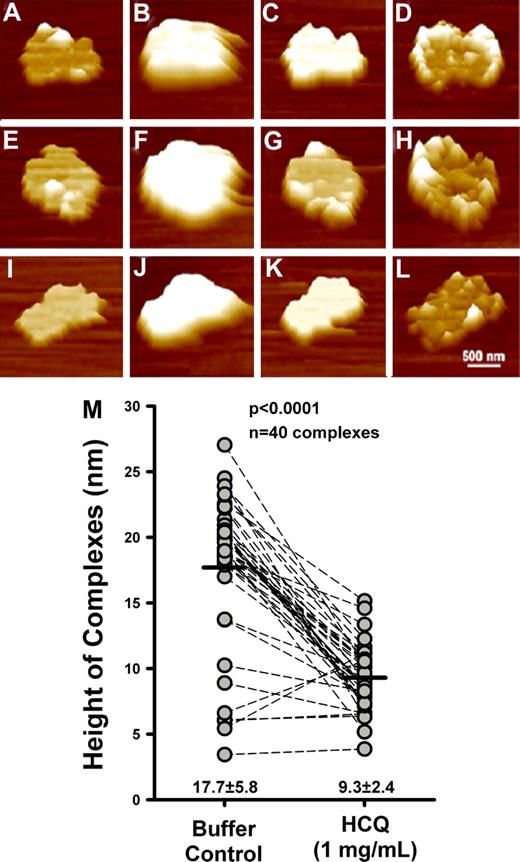 Figure 2. Atomic force microscopy (AFM) height images (3-dimensional view with 50° pitch) showing the effect of HCQ on aPL mAb and β2GPI complexes on 3 separate complexes. (A,E,I) The binding of β2GPI to phospholipid bilayers. Addition of β2GPI (10 μg/mL) to buffer covering the phospholipid bilayers resulted in the formation of distinct structures raised above the bilayers. (B,F,J) The binding of aPL IgG mAb, IS4, to β2GPI prebound to phospholipids. Addition of aPL mAb (20 μg/mL) to the phospholipid-bound β2GPI shown in panels A, E, and I resulted in large aggregates of increased height (indicated by white color) composed of aPL mAb–β2GPI complexes over the bilayers. (C,G,K) The effect of HCQ at 1 mg/mL on the phospholipid-bound aPL mAb and β2GPI complexes. At 12 minutes after the addition of HCQ to the supernatant fluid covering the bilayer, the immune complexes, shown in panels B, F and J, were significantly eroded after addition of the drug. (D,H,L) The immune complexes, shown in panels B, F, and J, were further disintegrated at thirty minutes after the addition of HCQ (1 mg/mL). All images show complexes electronically zoomed from an original 30 μm × 30 μm scan. Images were minimally processed to remove scan lines. The color shades represent height variations in the images, with the darker colors (rust) indicating lower heights and the lighter colors (white), the higher profiles. (M) Quantitative analysis of the effects of HCQ on 40 randomly encountered aPL mAb–β2GPI complexes. The height of the immune complexes at 12 minutes after the addition of HCQ (1 mg/mL) was significantly decreased (17.7 ± 5.8 nm; vs 9.3 ± 2.4 nm for the height before addition of HCQ).