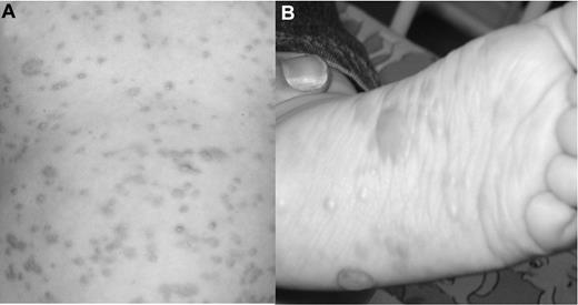 Figure 1. Skin changes before imatinib therapy. (A) Generalized macules and papules accompanied by severe pruritus on trunk and extremities. (B) The patient showed increasing numbers of bullous lesions on the extremities, especially on both feet.