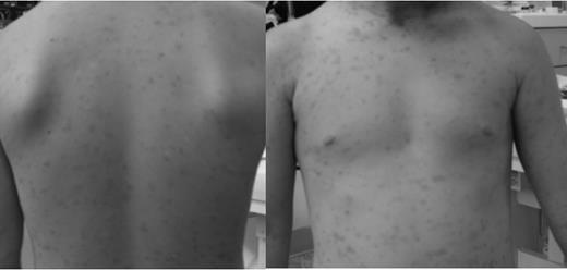 Figure 2. Skin status after imatinib therapy. The patient shows faint macular lesions without any accompanying symptoms.