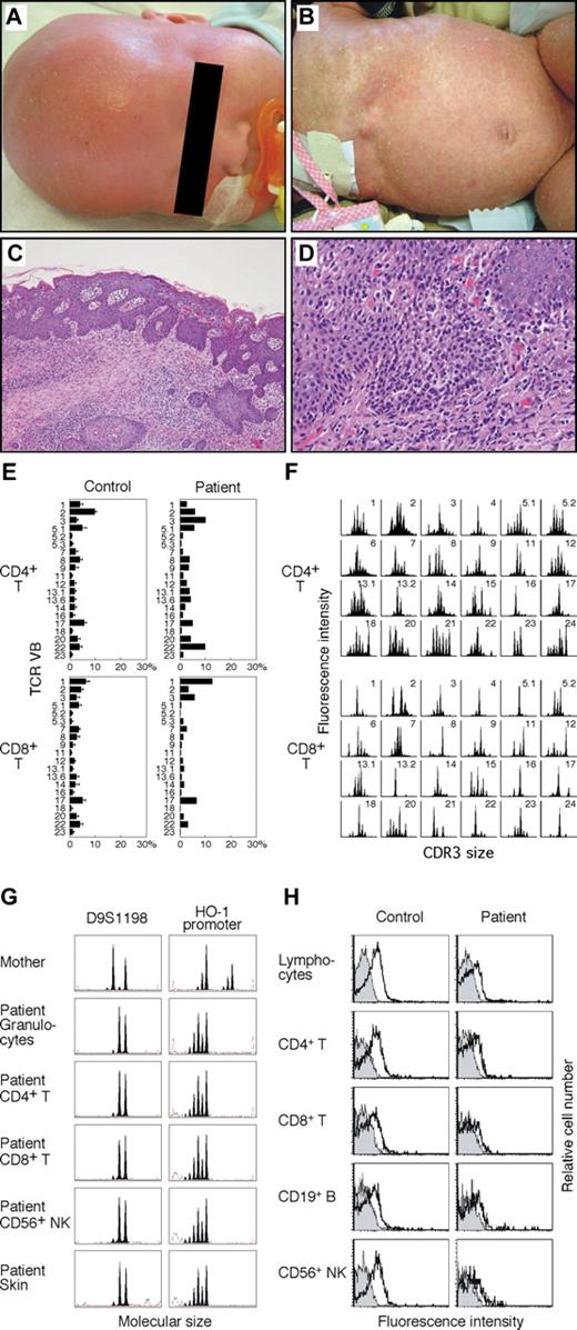 Figure 1. Skin lesions, skin biopsy specimen, T-cell receptor repertoire, microsatellite markers, and γc expression. (A) Alopecia. (B) Generalized scaling erythroderma. (C) Hematoxylin and eosin, original magnification ×40. (D) Hematoxylin and eosin, original magnification ×100. Micrographs were acquired using an Olympus BX51 microscope (Olympus, Melville, NY) fitted with 10× eyepieces, Olympus UPlanApo 4×/0.10 numeric aperture and 10×/0.40 numeric aperture objectives, a CoolSNAP cf CCD camera (Photometrics, Tucson, AZ), and Openlab image acquisition software version 3.1 (Improvision, Waltham, MA). Images were processed in Photoshop CS2 (Adobe Systems, San Jose, CA). (E) Expression profile of TCR variable β (VB) subfamilies. Peripheral blood samples were stained with monoclonal antibodies (mAbs) for individual TCR VB together with anti-CD4 and anti-CD8 mAbs. The percentage of each TCR VB expression within CD4+ or CD8+ T cells was analyzed by FACS. Error bars represent SD. (F) CDR3 spectratyping. Each TCR VB fragment was amplified from cDNA with one of the VB-specific primers. The size distribution of PCR products was determined by an automated sequencer and GeneScan software. (G) Microsatellite analysis. Two different markers were amplified with FAM-labeled specific primers and subjected to GeneScan analysis. HO-1 indicates heme oxygenase-1. (H) Analysis of γc expression. Shown are the results of γc expression on lymphocytes and lymphocyte subsets. Solid peaks indicate control Ab; open peaks represent anti-CD132 mAb.