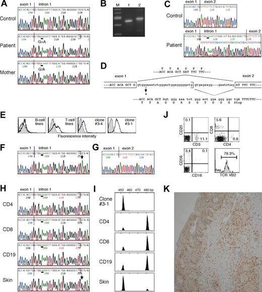 Figure 2. Characterization of inherited IL2RG gene mutation, second-site suppressor mutation, and skin-infiltrating lymphocytes. (A) The IL2RG gene was amplified from DNA extracted from normal, the patient's, and the mother's peripheral blood mononuclear cells (PBMCs). Direct sequence was performed using an automated sequencer. Bars show the locations of the mutation. (B) RT-PCR analysis for IL2RG mRNA using PBMCs obtained from normal control (lane 1) and the patient (lane 2). Lane M contains a 100-bp molecular size marker. (C) Direct sequence analysis of IL2RG cDNA using PBMCs from normal control and the patient. (D) Schematic representation of effect of the inherited splice-site mutation. (E) Analysis of γc expression. Shown are the results of γc expression on B-cell and T-cell lines, and cloned T cells #3-4 and #3-1 established from the patient. (F) Direct sequence analysis of IL2RG gene using DNA obtained from the clone #3-1. A bar shows the locations of the inherited mutation and an arrow highlights the second-site mutation. (G) Direct sequence analysis of IL2RG cDNA from the clone #3-1. (H) Direct sequencing analysis of IL2RG gene using DNA obtained from the patient's primary CD4+ and CD8+ T cells and CD19+ B cells, and his skin. (I) GeneScan analysis of IL2RG cDNA amplified from the clone #3-1, the primary lymphocytes including CD4+ and CD8+ T cells and CD19+ B cells, and the skin of the patient. A peak of the size of approximately 454 nucleotides represents wild-type mRNA and a second peak of approximately 482 nucleotides is generated by aberrant splicing. (J) FACS analysis of skin-infiltrating lymphocytes. The percentage of cells gated in each region is shown. (K) Immunohistochemical staining of the skin biopsy specimen. The samples were stained with anti-CD8 mAb.