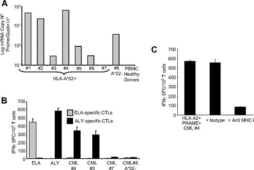 Figure 5. PRAME CTLs can target PRAME+ CML tumor cells. (A) Expression of PRAME mRNA in PBMCs isolated from 8 patients with CML and from a pool of 4 representative healthy donors. In 1 of the HLA-A*02+ CML patients, PRAME mRNA was undetectable (< 10−1 normalized copies) as in healthy donors. (B) shows IFNγ production by PRAME CTLs (■) or by ELA-specific CTLs () generated from healthy donors against blasts obtained from CML patients. Significant numbers of IFNγ + SFC were detected in response to PRAME+/HLA-A*02+ CML cells (patients 3 and 4) but not in response to HLA-A*02+ CML cells with undetectable PRAME expression (patient 7) or PRAME+/HLA-A*02− CML cells (patient 8). Negligible numbers of IFNγ+SFC were released by ELA-specific CTLs. (C) IFNγ production by PRAME CTLs in response to PRAME+/HLA-A*02+ CML cells is reduced by MHC class I antibody.