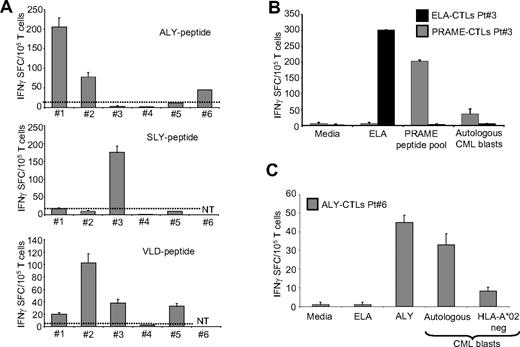 Figure 7. PRAME CTLs can be generated from HLA-A*02+ CML patients. (A) Frequency of IFNγ CTLs specific for ALY (top graph), SLY (middle graph), and VLD peptides (bottom graph) in 6 HLA-A*02+ CML patients. (B) PRAME CTLs produced IFNγ+ SFC in response to PRAME peptides and to autologous CML blasts. In addition, CTLs reacting against the ELA peptide (■) generated from the same patient did not produce IFNγ+ SFC when cocultured with autologous CML blasts. (C) PRAME CTLs produced IFNγ in response to autologous CML blasts but not to CML blasts from a PRAME+/HLA-A*02− patient (patient 8).