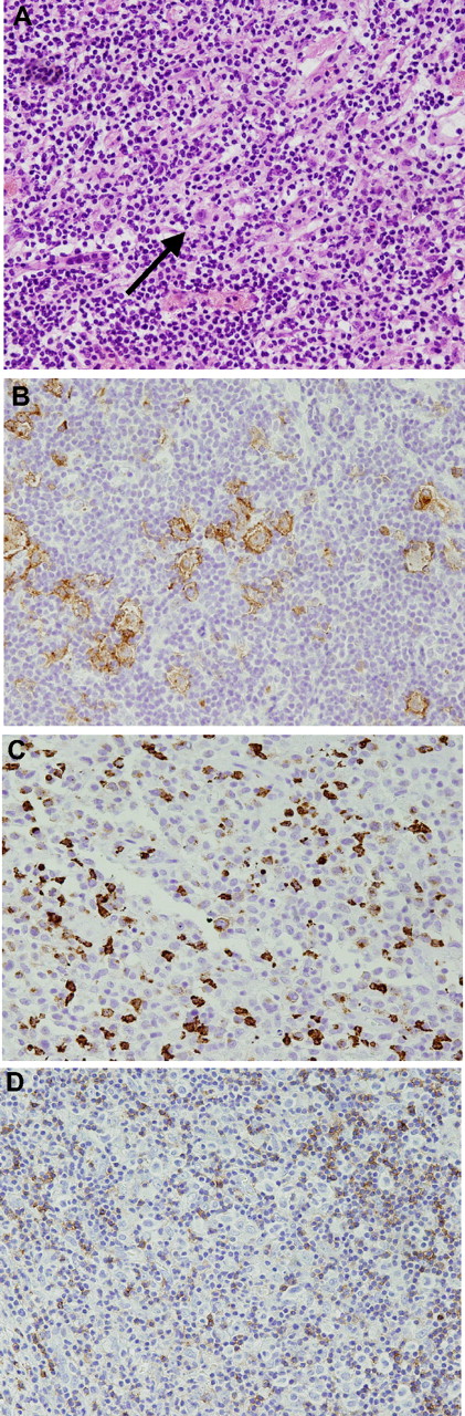 Figure 1. Histology from a patient with nodular sclerosis Hodgkin lymphoma involving the cerebellum. A Reed-Sternberg cell () is seen in the center of the panel (40×, hematoxylin-eosin stain) (A). The large cells stained for CD30 (B). The cells are focally CD15 positive (C) and CD45 negative (D). All images were acquired at 40× magnification using an Olympus CX411 microscope and an Olympus DP70 camera with medium acquisition software (Melville, NY).