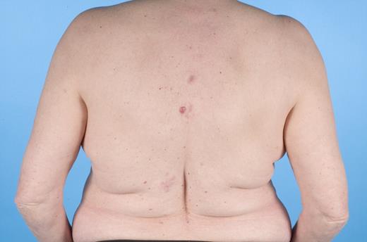 Figure 1. Primary cutaneous marginal zone lymphoma.