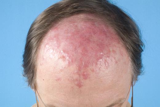 Figure 2. Primary cutaneous follicle center lymphoma.