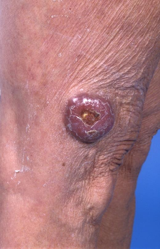 Figure 3. Primary cutaneous diffuse large B-cell lymphoma, leg type.
