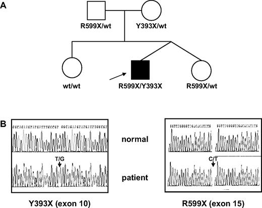 Figure 1. TMPRSS6 genotypes in the family. (A) Pedigree of the family. (B) Sequencing traces from exon 10 and exon 15 of TMPRSS6. Arrows indicate heterozygous nucleotide substitutions leading to Y393X and R599X nonsense codons. wt indicates wild-type.