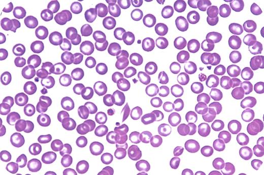 A 52-year-old African-American man had a mild anemia (hemoglobin of 103 g/L) and target cells on the peripheral blood smear as shown. The white blood cell and platelet counts were normal. The referring physician assumed that a hemoglobinopathy could be present and a hemoglobin electrophoresis showed hemoglobin AC. He was referred for the hemoglobinopathy. / Certainly, the appearance of targeted red cells raises the possibility of hemoglobinopathies (such as hemoglobin S, hemoglobin C, and hemoglobin E), as well as acquired disorders. However, the presence of hemoglobin C in this patient's electrophoresis does not provide the reason for his anemia. The hemoglobin C carrier state (AC) is not associated with anemia. When a complete evaluation was performed, the stool was hemoccult positive and an early colon carcinoma was found.