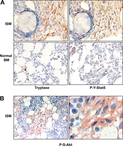 Figure 3. Immunohistochemical detection of P-Y-Stat5 and P-S-Akt in neoplastic human mast cells. (A) Adjacent bone marrow (BM) sections from a patient with indolent systemic mastocytosis (ISM) and normal bone marrow (normal BM) sections were stained with an antibody against tryptase for MC detection (brownish staining) and an antibody against P-Y-Stat5 (brownish staining). (B) Similarly, bone marrow sections from a patient with indolent systemic mastocytosis were stained with an antibody against P-Ser473-Akt antibody. Higher magnification of the immunostaining (×400) is also shown.