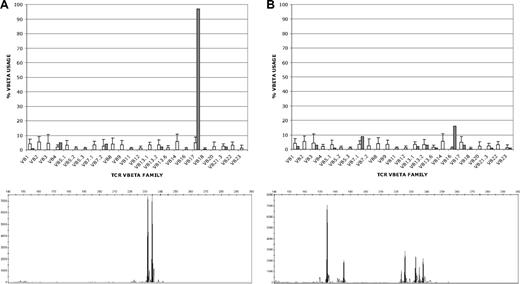 Figure 3. Clonality of T cells produced by limiting dilution and in bulk culture. T-cell clonality was determined by flow cytometric T-cell receptor (TCR) Vβ spectratyping (top) and by PCR amplification of clonal V-J rearrangements at the TCRγ locus (bottom). Representative results for T cells produced by limiting dilution (A) and in bulk culture (B) are shown. (A) T cells produced by limiting dilution (patient B), showing clonal expression of Vβ17 in 98% of CD8+ T cells by Vβ spectratyping (top; ■) and showing 2 predominant TCRγ rearrangements (bottom). Because each T-cell clone can rearrange one or both of its TCRγ alleles, the 2 PCR products could represent either 1 T-cell clone with biallelic TCRγ rearrangements or 2 singly rearranged clones, although the single predominant Vβ17 clone identified by spectratyping would favor a single doubly rearranged clone. (B) T cells produced in bulk culture (patient G) showing oligoclonal Vβ expression in CD8+ T cells (16% Vβ16; 9% Vβ7.1; 3% each Vβ3, Vβ13.2 and Vβ17; 2% each Vβ1 and Vβ13.1; and 1% each Vβ5.1, Vβ13.6, Vβ21.3, and Vβ23) and 7 distinct TCRγ rearrangements by PCR (bottom; ■) that could correspond to between 4 and 7 different T-cell clones, depending on the number of singly and doubly rearranged clones (see Table S1). The □ in both top panels represent the average expression levels for each Vβ chain in normal polyclonal T-cell populations.