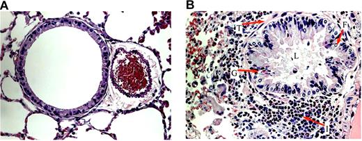 Figure 4. Airway architecture in normal and sensitized mice. General pulmonary architecture in the unsensitized (A) and sensitized (B) mice. (A) In all groups of unsensitized mice, lung parenchyma was clear, lacy, and essentially devoid of inflammatory cells. (B) In the lung parenchyma of sensitized mice, epithelial folding and distortion (F), lumen narrowing (L), goblet cell metaplasia (G), eosinophil infiltration (I), and subepithelial fibrosis (basement membrane thickening, T) are evident. All images were captured at a magnification of 40×.